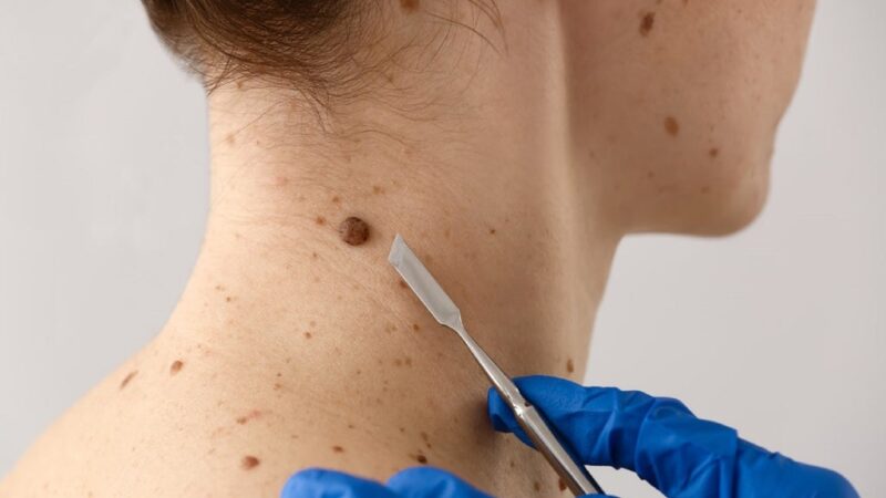 Formosa se suma durante toda esta semana a la Campaña Nacional de Prevención del Cáncer de Piel