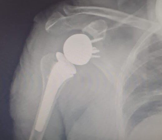 HAC: Se realizó la primera prótesis reversa de hombro