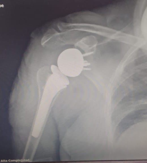 HAC: Se realizó la primera prótesis reversa de hombro